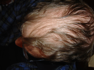 התקרחות ונשירת שיער. מקור: ויקיפדיה ברשיון cc3-by-sa מאת: Quadell-Macgyver30