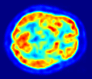 סריקת מוח PET. מקור: ויקיפדיה ברישיון. צילום: Jens Langner