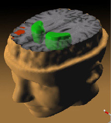 הדמיית צילום מוח של חולי סכיזופרניה. מקור: ויקיפדיה ברשיון חופשי לשימוש. איור באדיבות המכון הלאומי לבריאות בארה