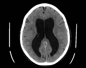 סריקת CT מוח של חולה. מקור: ויקיפדיה ברשיון -cc3-by-sa. צילום: Lucien Monfils