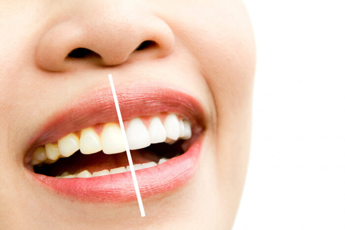 Teeth Whitening Treatment Freepik E1683640507737 